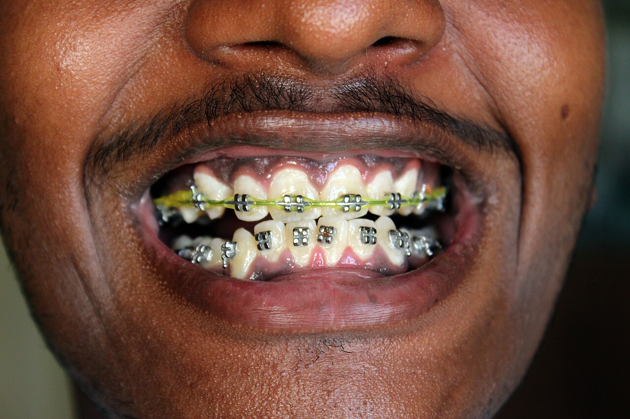 Close-up of metal braces with brackets and wires on teeth
