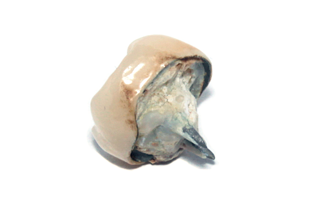 Dental crown before placement