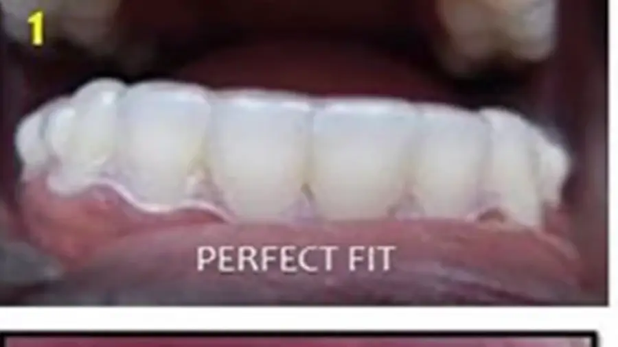 Clear aligner fully seated against the edges of the teeth with no visible gap