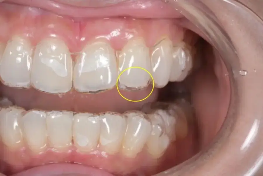 Clear aligner with a small gap at the biting edge of one front tooth