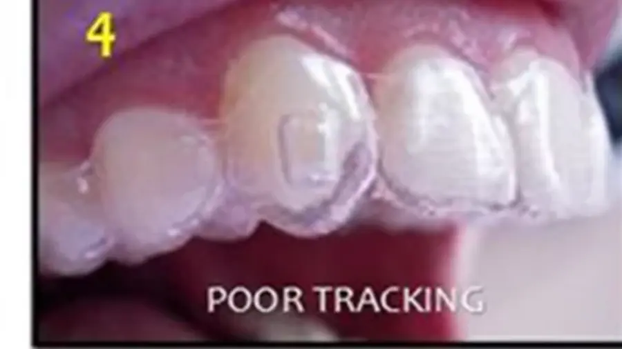 Clear aligner with visible spaces between the tray and several teeth